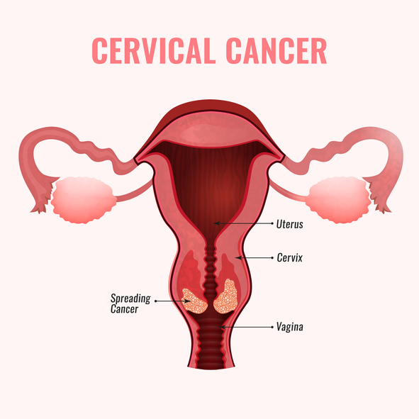 국내 여성 암 중 발생율 4위 자궁경부암
